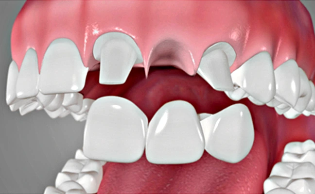 Types and Benefits of Dental Bridges in Cary NC