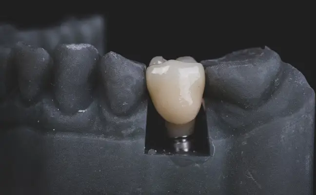 Dental Bridge vs Implant: What's the Difference?