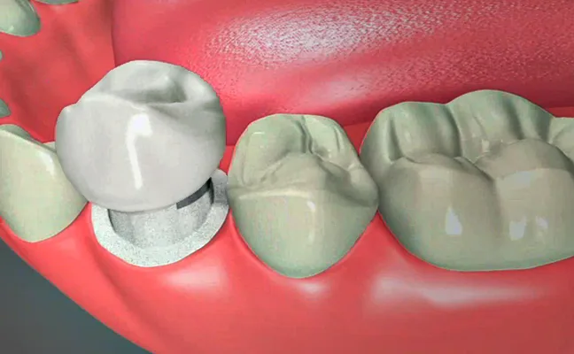 Dental Crowns in Apex and Cary NC