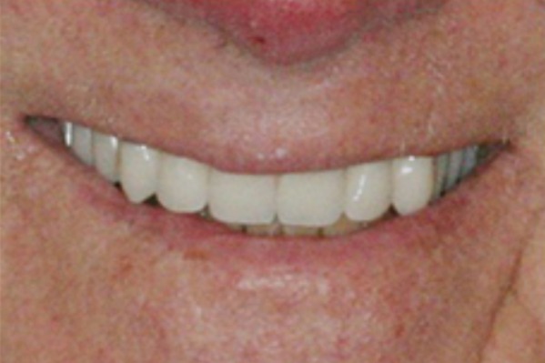 anterior-crowns-after