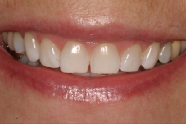 smile-design-upper-anteriors-after