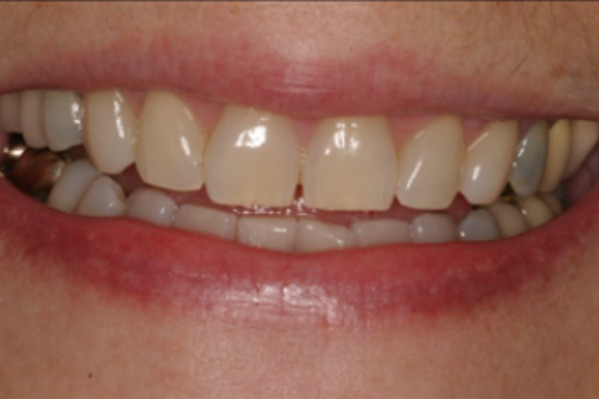 smile-design-upper-anteriors-before