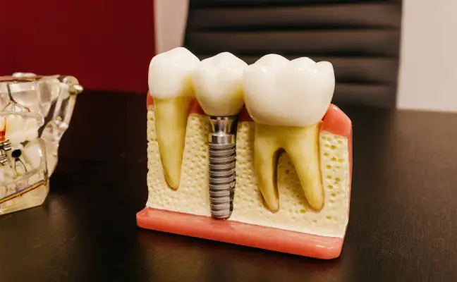 are-same-day-dental-implants-ideal-for-you-cary