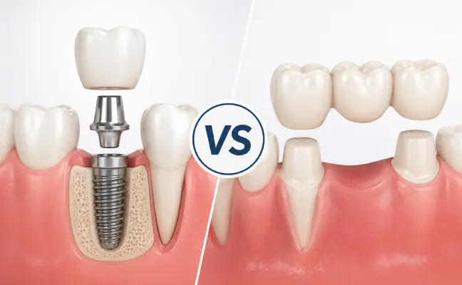 Helpful dental information about dental bridge in Apex NC