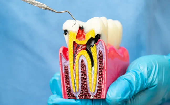 Clearing Misconceptions on Root Canal Treatment in Cary, NC