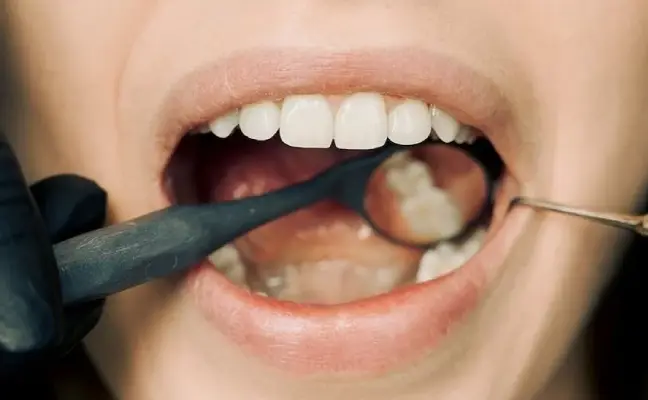 How Long Do Dental Veneers Last?