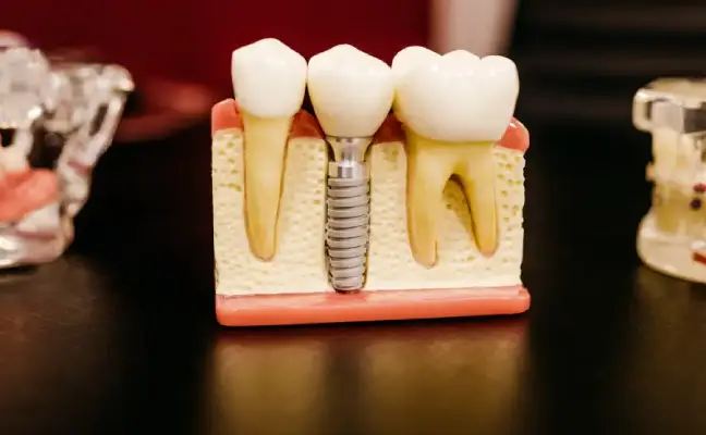 Expert Dental Implant Care Tips