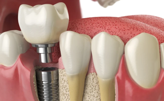 Step-by-Step Process of Implant Dentistry in Cary, NC Step-by-Step Process of Implant Dentistry in Cary, NC
