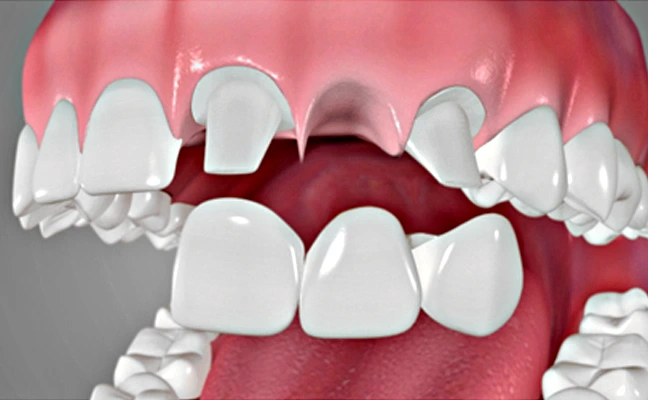 Dental Bridges Apex and Cary NC