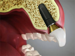 Dental Implants