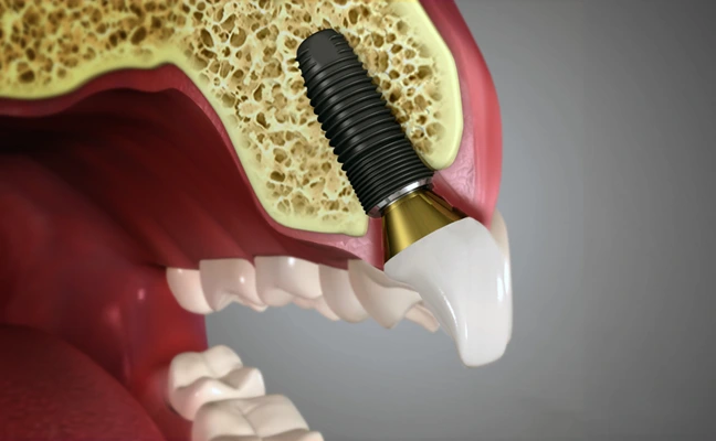 Improving Quality of Life with Dental Implants | Cary NC