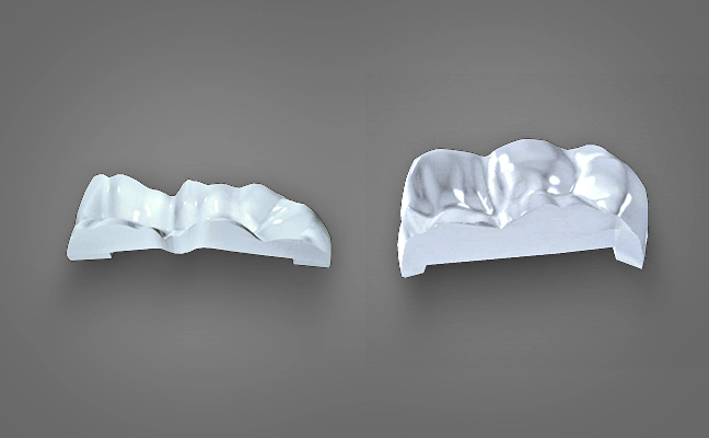 Dental Inlays Onlays