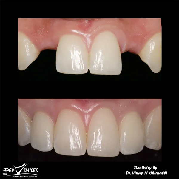 Dental implants